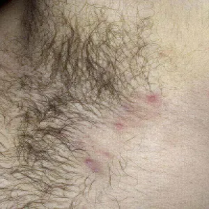 krosty pod pachami zapalenie mieszków włosowych