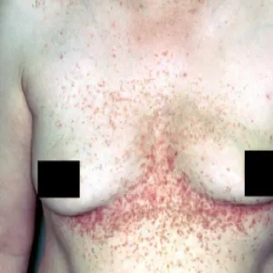 Krosty pod piersiami