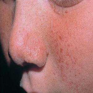 Krosty w kolorze skóry na twarzy choroba gruczolak łojowy