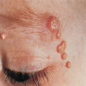 Krosty w okolicy oka mięczak zakaźny