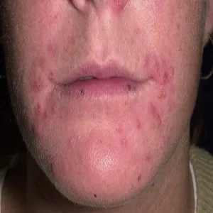 Krosty wokół ust zapalenie mieszków włosowych