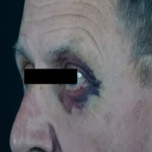 Krwiak okołooczodołowy  amyloidozy skóry