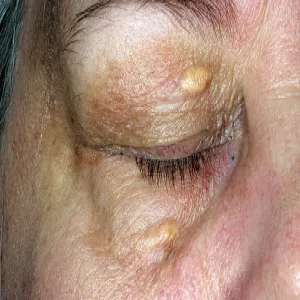 Ksantomatozy zdjęcia 