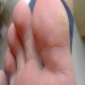 Kurzajki na dużym palcu stóp