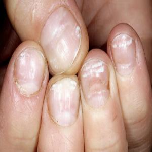 Leukonychia bielactwo paznokci