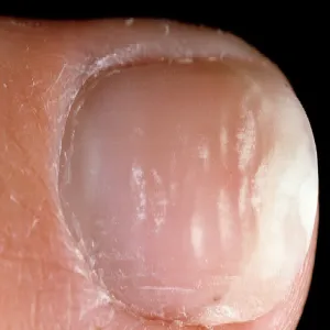 Leukonychia partialis