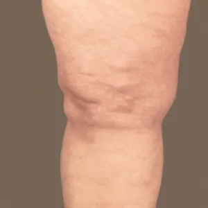 Liczne małe tłuszczaki na nodze choroba Dercuma