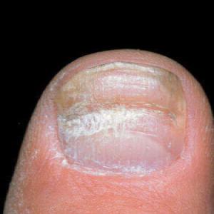 Linie Beau głębokie rowki wgniecenia na paznokciu