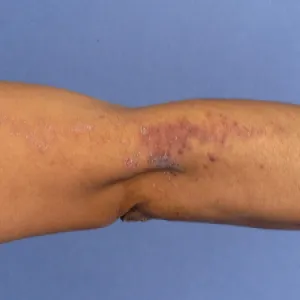 Liniowy liszaj płaski rąk