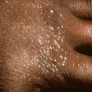 Liszaj lśniący choroba skórna