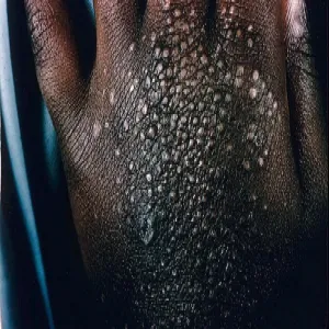 Liszaj lśniący na dłoni