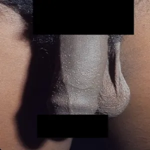 Liszaj lśniący na penisie