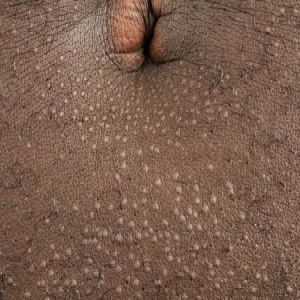 Liszaj lśniący zdjęcie