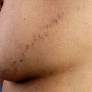 Liszaj płaski liniowy na piersi