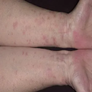 Liszaj płaski na nadgarstkach obu dłoni