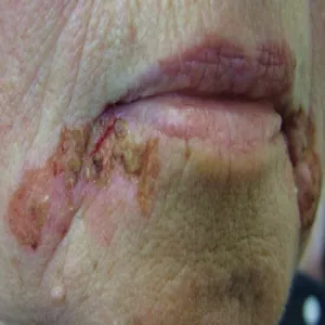 Liszajec u dorosłych 