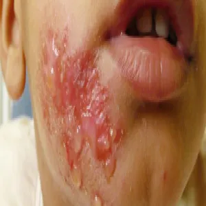 Liszajec wysypka pęcherzykowo-krostkowa