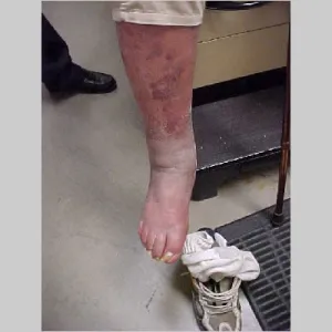 Lokalne zaczerwienienie powierzchni skóry wyprysk żylakowy