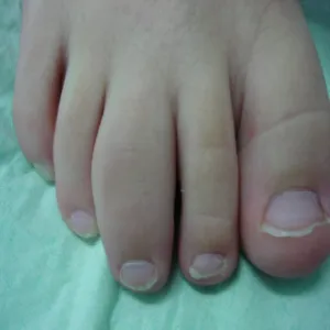 Młodzieńcze reumatoidalne zapalenie stawów u dziecka