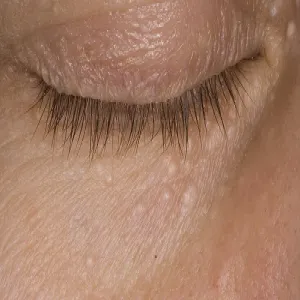 Małe, białe grudki syringoma