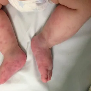 Małopłytkowość immunologiczna u dziecka