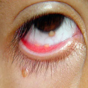 Mały guzek pod okiem żółtakoziarniniakowatość młodzieńcza 