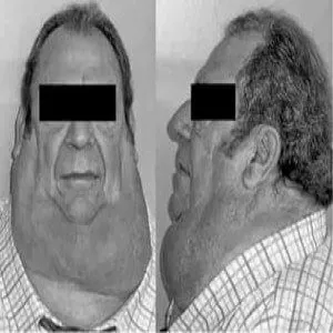 Madelung’s disease