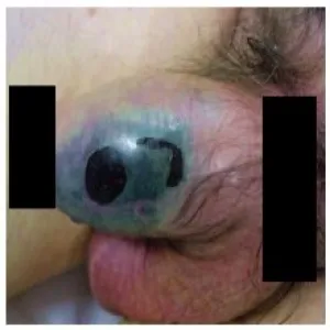 Martwicze zakażenie prącia