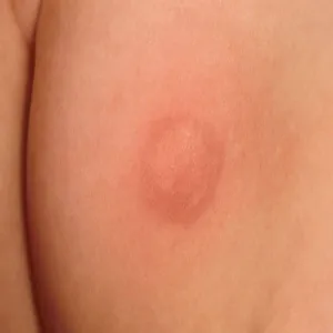 Mastocytoza skórna jak wygląda u dziecka