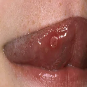 Mastocytozy na języku