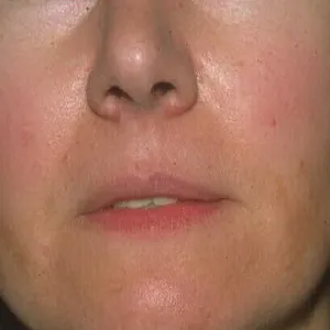 Melasma po ciąży