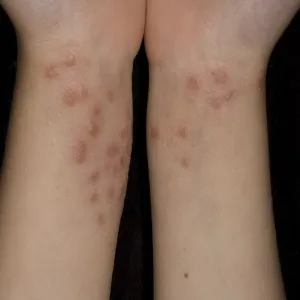 Mięczak zakaźny na nadgarstkach