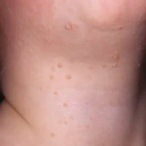 Mięczak zakaźny na szyi