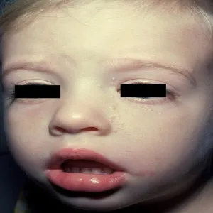 Mięczak zakaźny na twarzy u dziecka