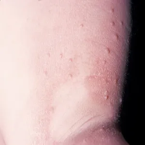 Mięczak zakaźny objawy