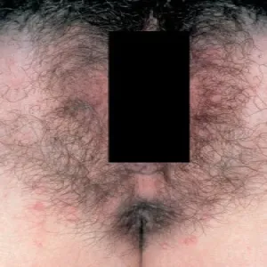 Mięczak zakaźny okolice intymne u kobiet