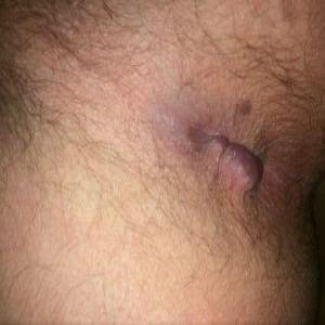 Miękki guzek przy odbycie hemoroidy