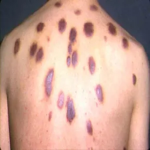 Mięsak Kaposiego na szyi