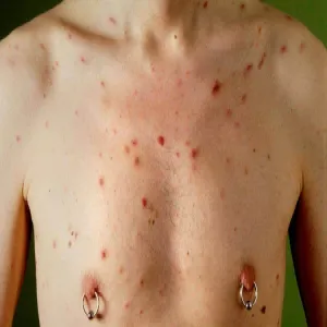 Mięsak Kaposiego u chorego na HIV