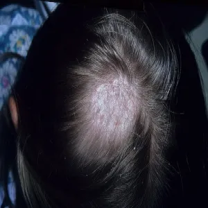 Microsporum canis grzybica skóry głowy