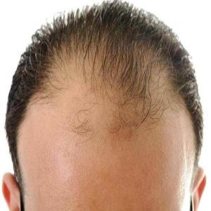 Mniej włosów po jednej stronie głowy łysienie androgenowe 
