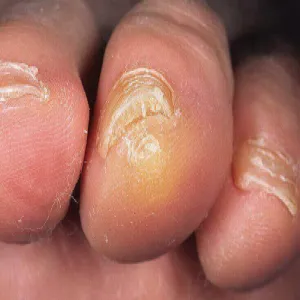 Modzel na palcu stopy