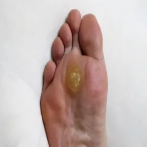 Modzel na podeszwie stóp 