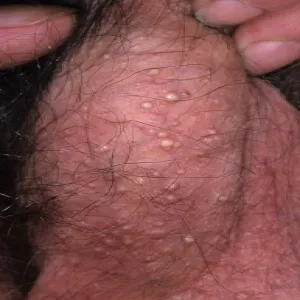 Moszna choroby skórne kaszaki