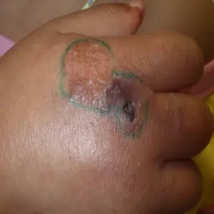 Mukormykoza czarny grzyb