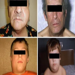 Mumps rubulavirus