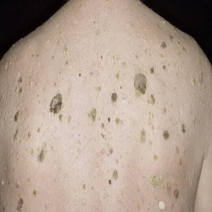 Na plecach brodawki łojotokowe