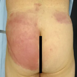 Naciek zapalny o żywoczerwonej barwie