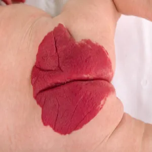 Naczyniak rozgałęziony zdjęcie