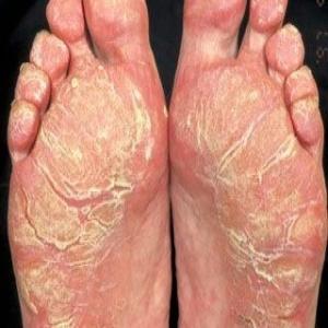 Nadmierne rogowacenie skóry na stopach
